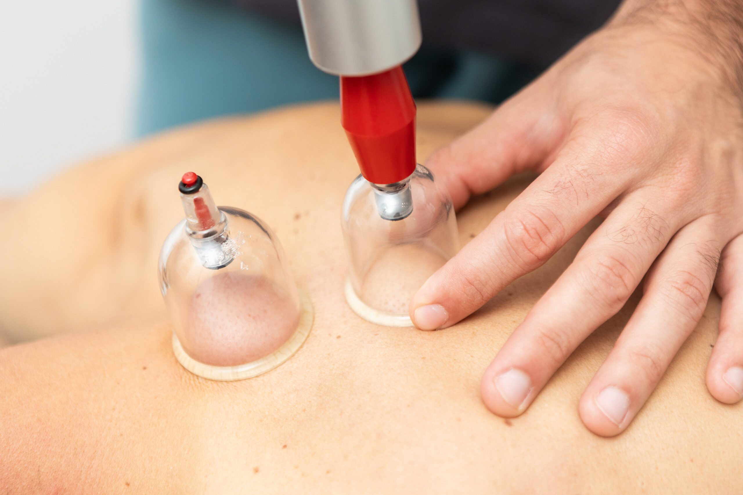 Cupping o tratamiento con ventosas en La Laguna